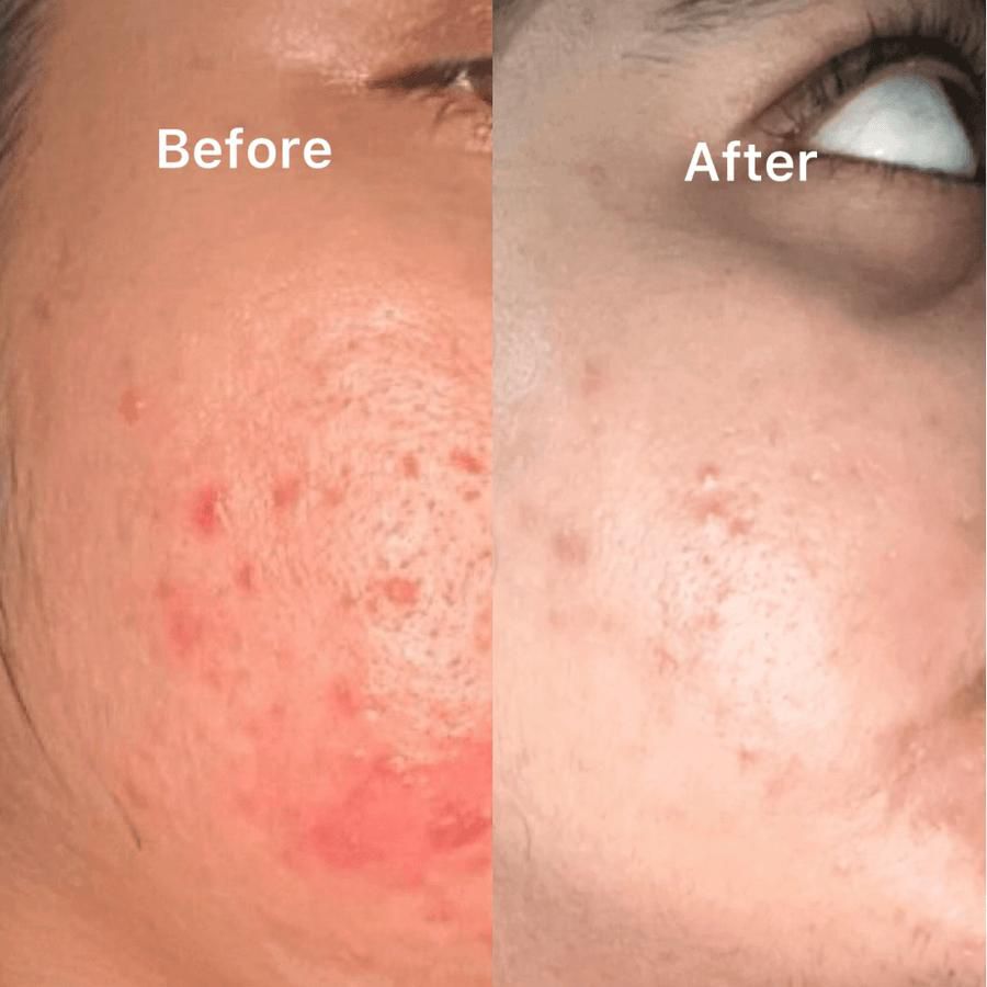 The Ordinary - Alpha Arbutin Facewash Of 100ml